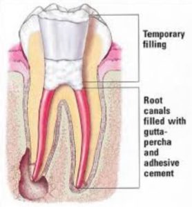 We offer affordable root canal therapy in Sydney.