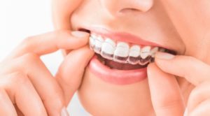 We are the best in providing Invisalign here in Sydney.