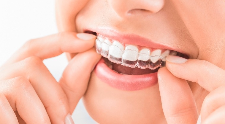 We are the best in providing Invisalign here in Sydney.