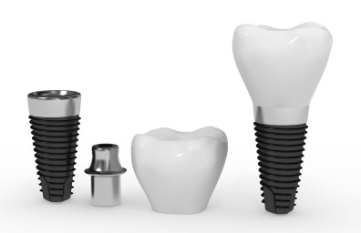 Dental Implants in Sydney