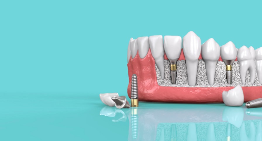 Dental Implants in Sydney