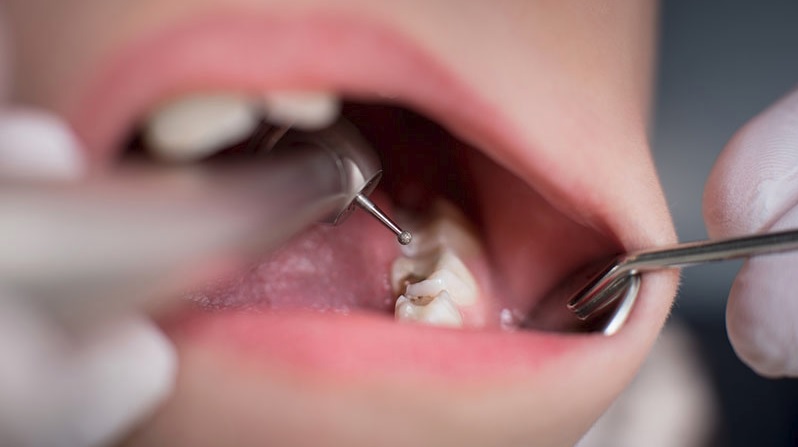 Dental Fillings in Sydney