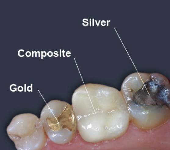 Dental Fillings in Sydney