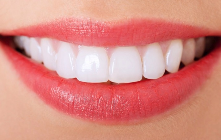 Professional teeth whitening in Sydney