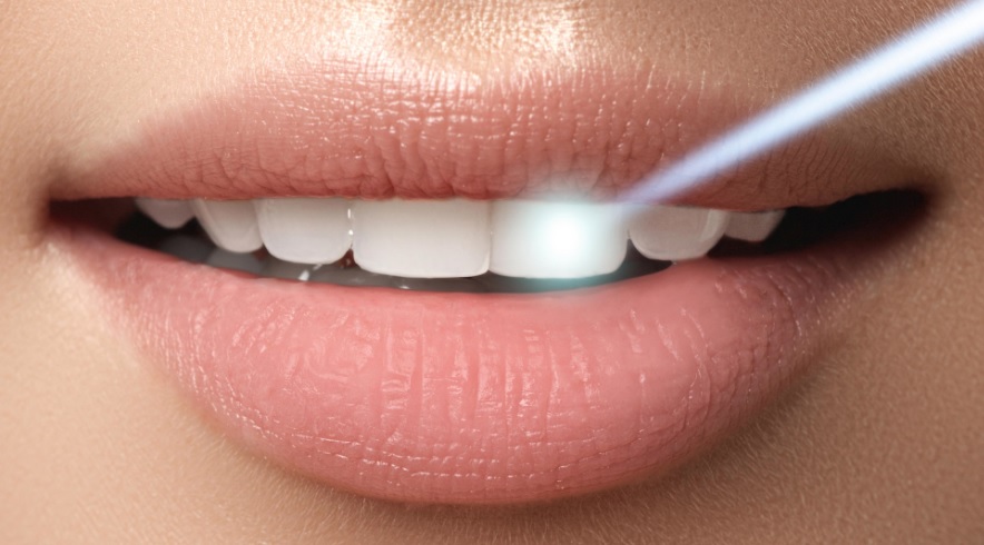 Professional Teeth Whitening in Sydney