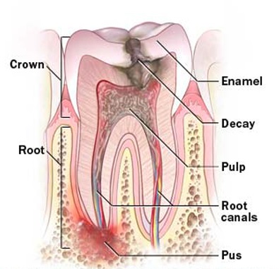 Root canal treatment cost in Sydney