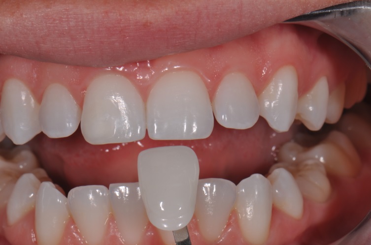 Veneers in Sydney