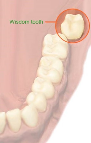 Wisdom teeth removal in Sydney