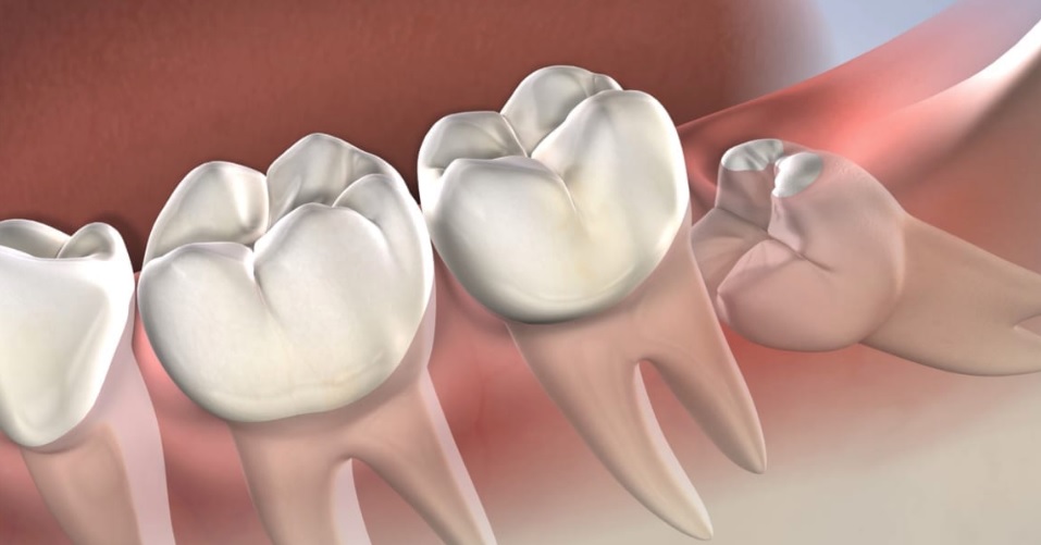 Wisdom teeth removal in Sydney