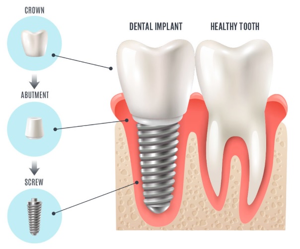 Teeth Implant in Sydney