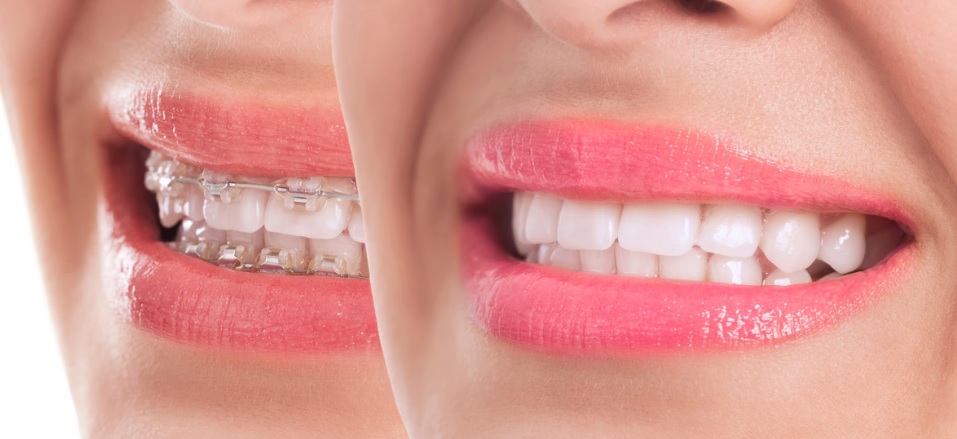 Orthodontics cost in Sydney