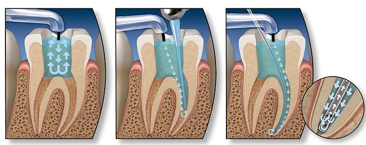 Root canal therapy in Sydney