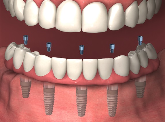 Full Dental Implants in Sydney