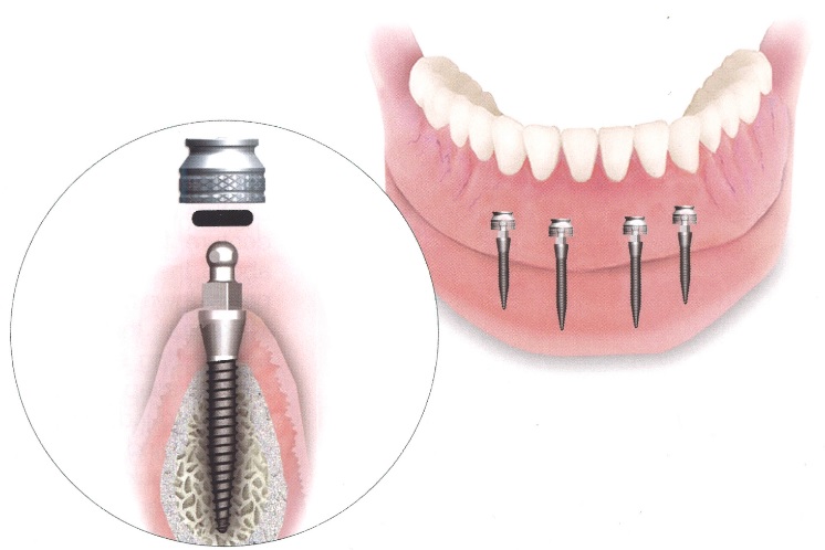 Mini Dental Implants in Sydney