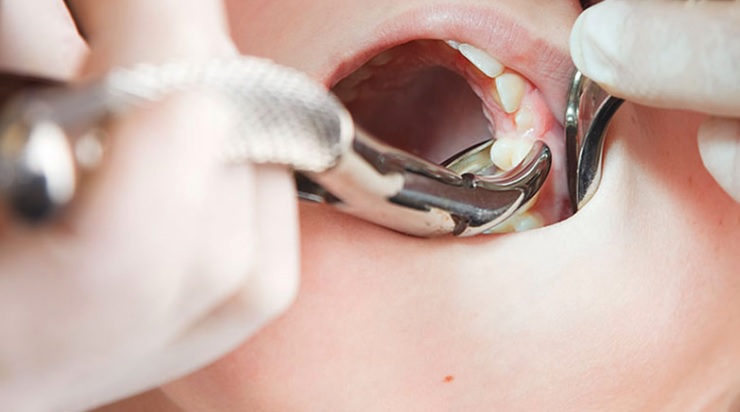 Tooth removal in Sydney
