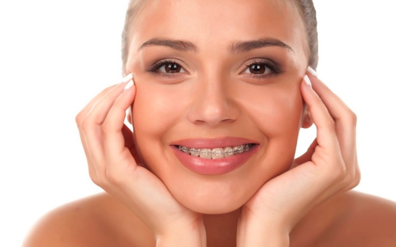 Adult Braces in Sydney