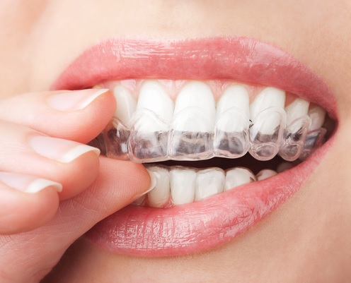 Adult Braces in Sydney