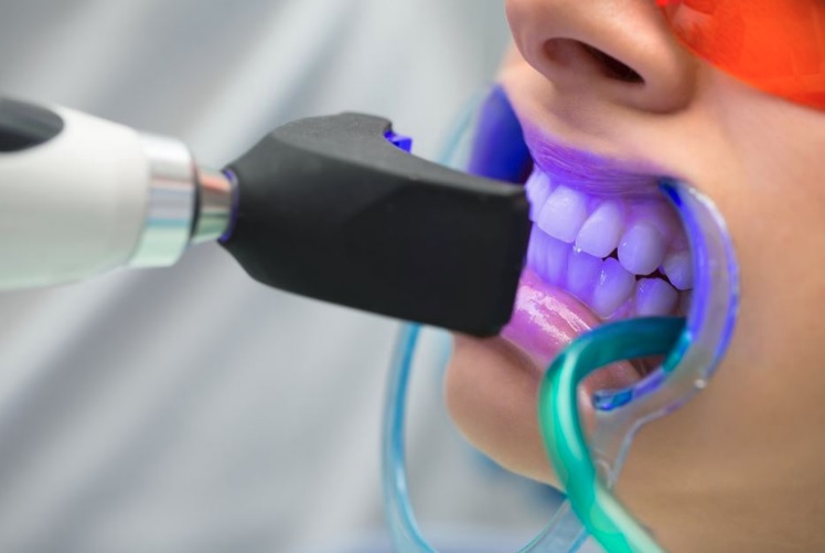 Teeth Whitening Procedure in Sydney