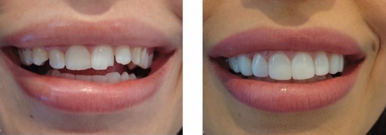 Composite Veneers in Sydney