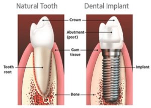 Tooth implant cost in Sydney