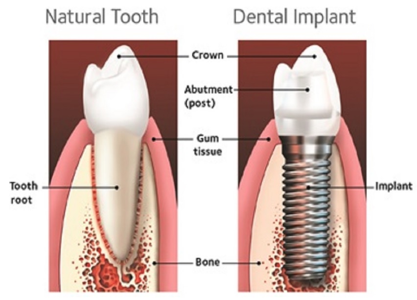 Tooth implant cost in Sydney