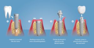Tooth implant process in Sydney