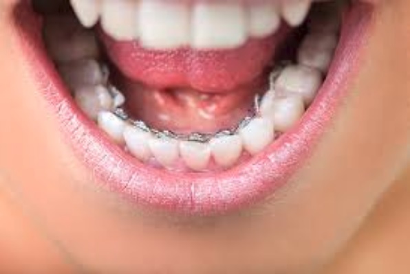 Braces Cost in Sydney