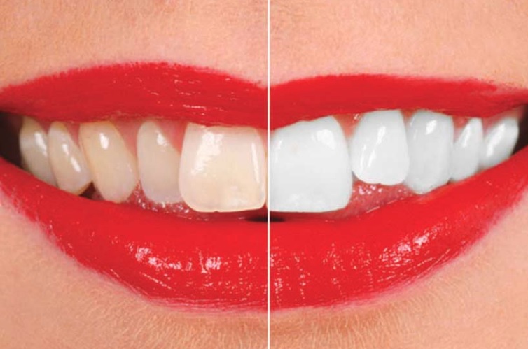 Teeth Whitening in Sydney