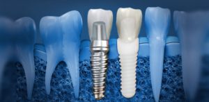 Best Dental Implants in Sydney