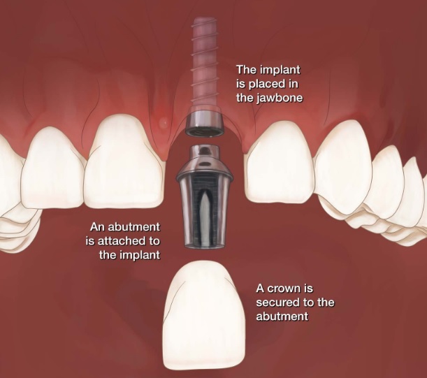 Best Dental Implants in Sydney