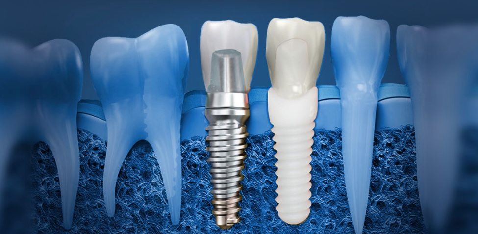 Best Dental Implants in Sydney