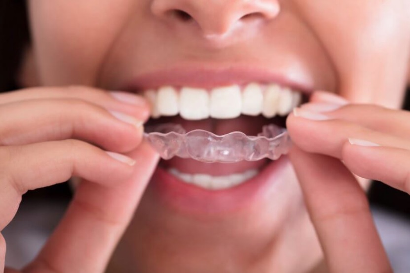 Invisalign in Sydney