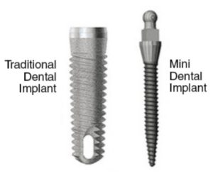 Mini dental implants in Sydney
