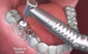 Single tooth implant cost in Sydney