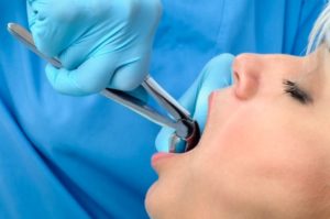 Tooth Extraction Aftercare Tips in Sydney