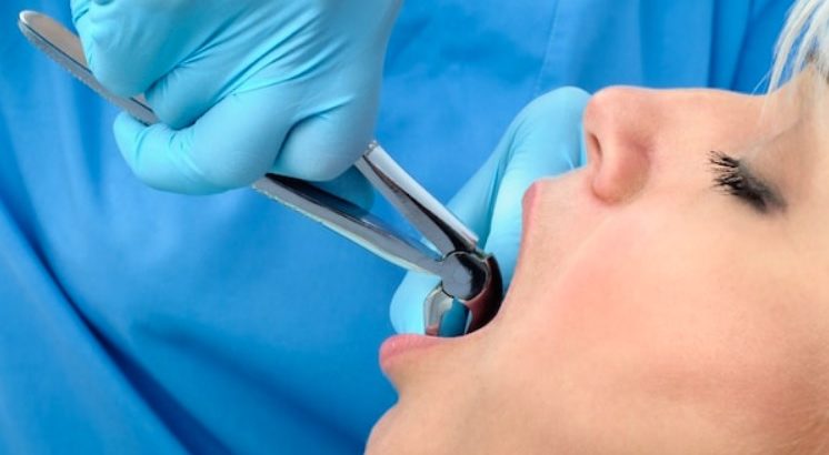 Tooth Extraction Aftercare Tips in Sydney