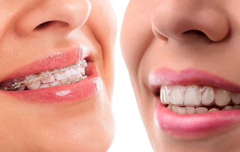 Invisalign vs braces cost