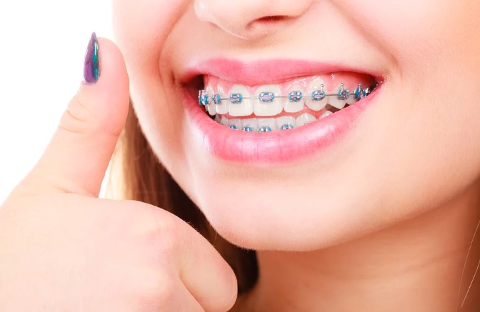 braces cost