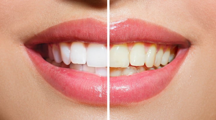 Teeth Whitening