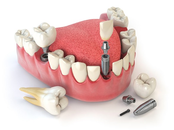 dental implants cost in Sydney