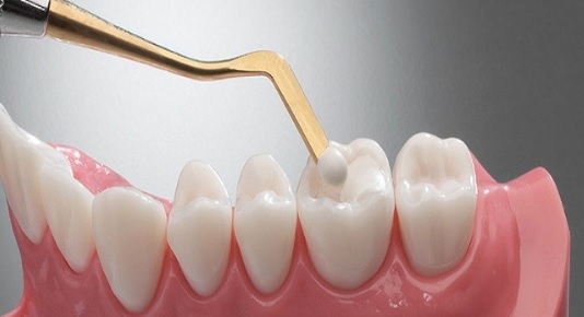 Aesthetic Dental Fillings: Types, Benefits, and Considerations