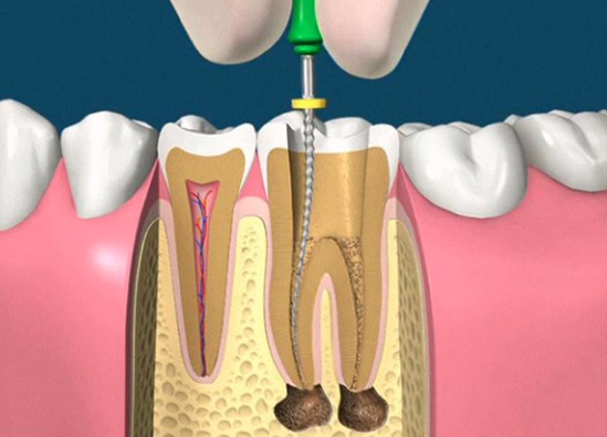 root canal therapy in Sydney