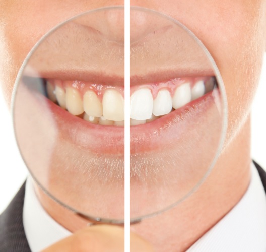 teeth whitening cost in Sydney