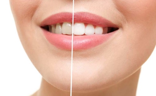 Sydney teeth whitening