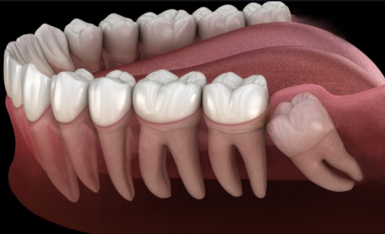 wisdom teeth removal in Sydney