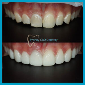 Estelite BW direct veneers at Sydney CBD Dentistry