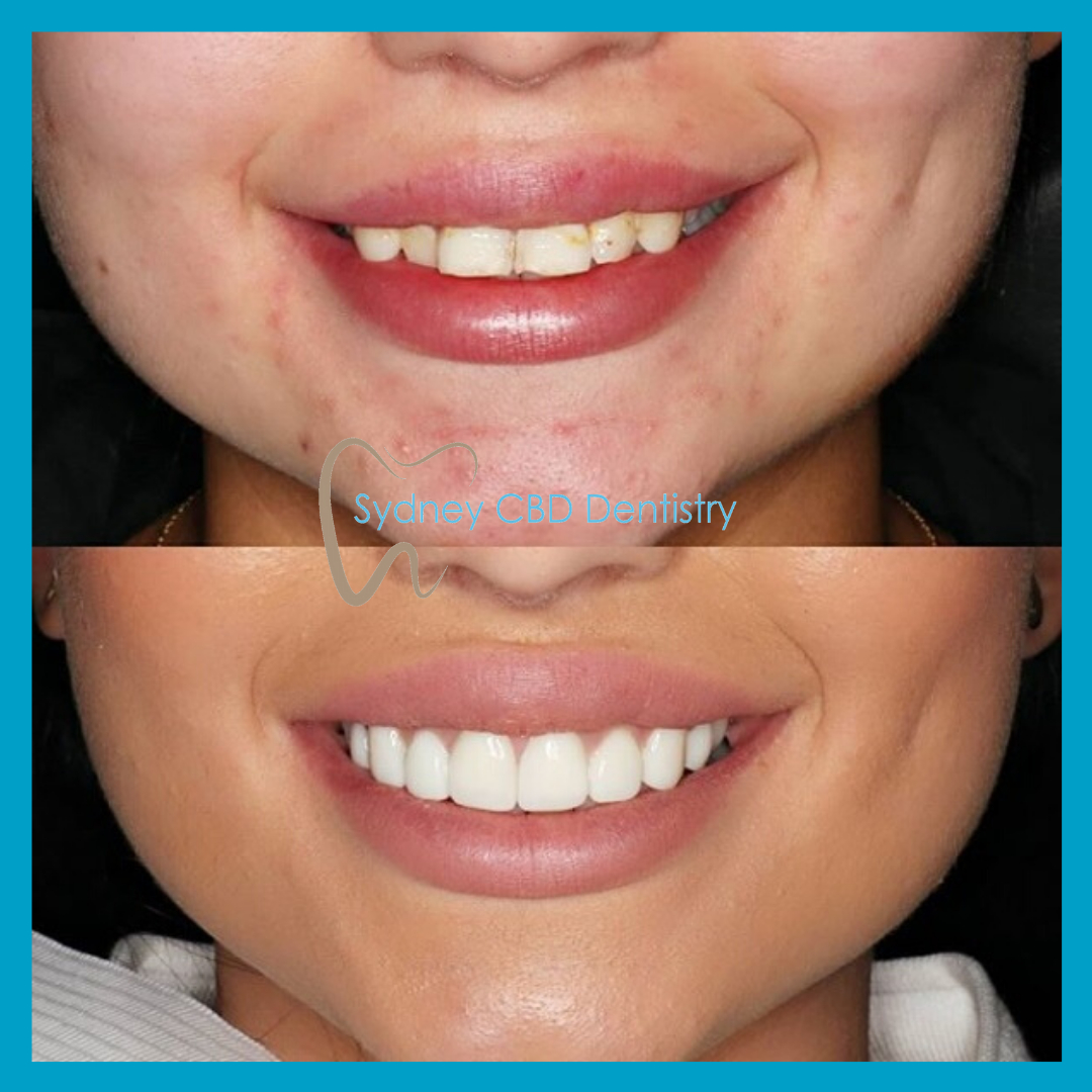 direct veneers from Sydney CBD Dentistry