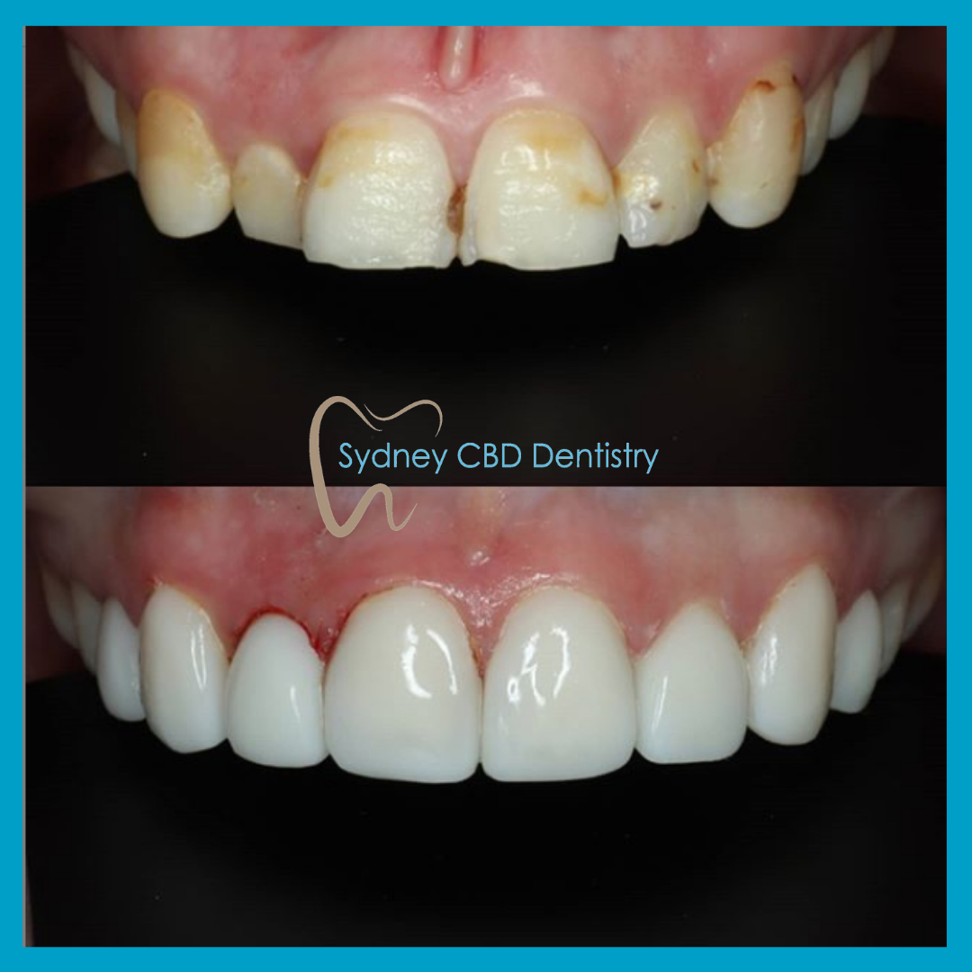 direct veneers in Sydney CBD Dentistry