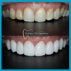 Emax Veneers at Sydney CBD Dentistry