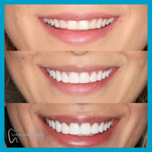 Emax BL2-LT veneers done by Dr Mark Nieh at Sydney CBD Dentistry